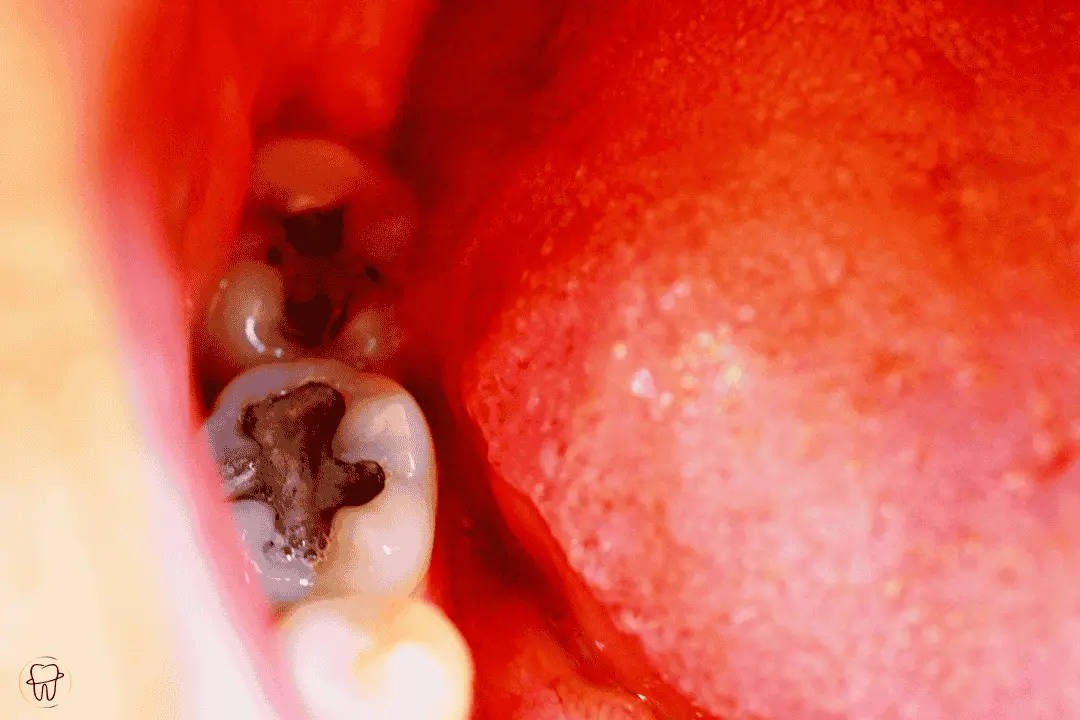 Wurzelkanalbehandlung in der Zahnarztpraxis Oerlikon