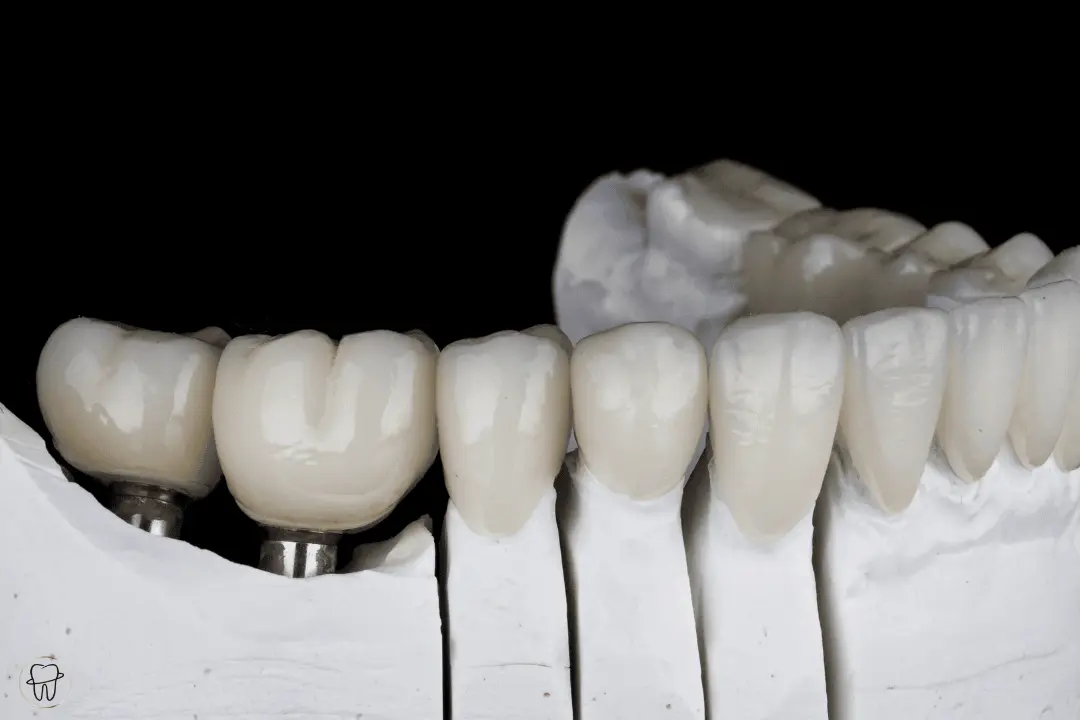 Zirkon Kronen und Brücken